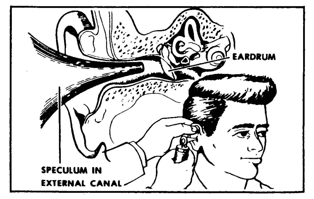 6-7. PROCEDURES TO IRRIGATE THE EAR