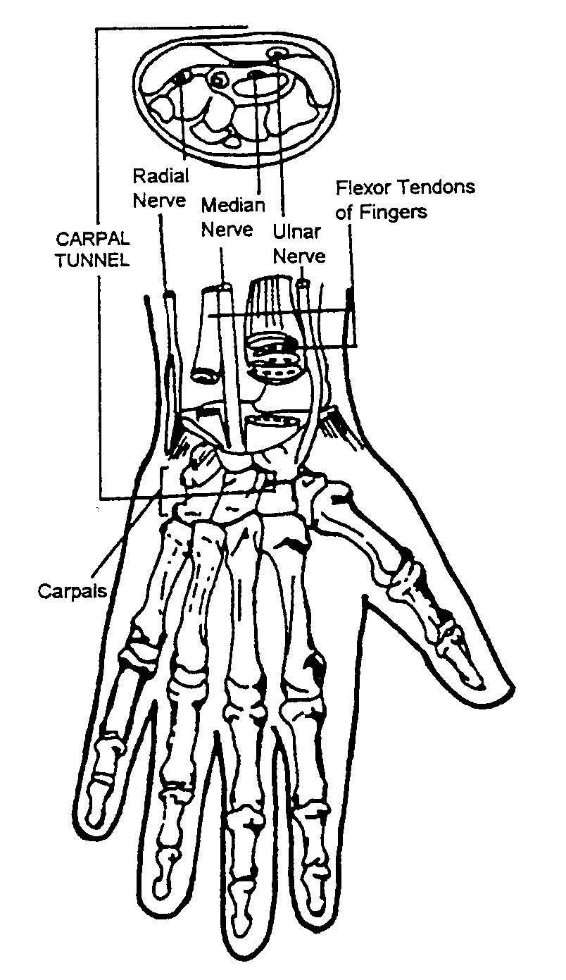 plantar neuroma