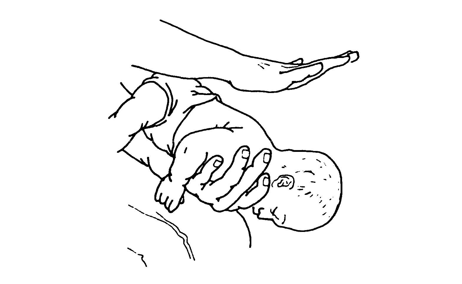 7-3. REMOVE UPPER AIRWAY OBSTRUCTION IN A CONSCIOUS INFANT