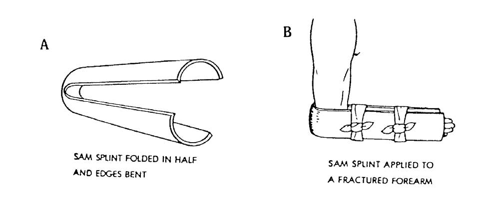 5-2. IMMOBILIZE A FRACTURED FOREARM WITH A SAM SPLINT