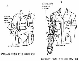 5-5. IMMOBILIZE A FRACTURED ELBOW WITH AN IMPROVISED SPLINT